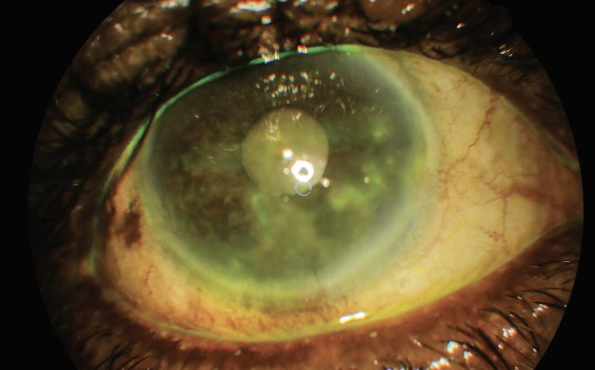 The potential benefit of suppressive valacyclovir varied across the 18-month ZEDS follow-up, with protective effects concentrated during early treatment and the observation period after therapy ended.